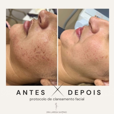 Protocolo de Clareamento Facial