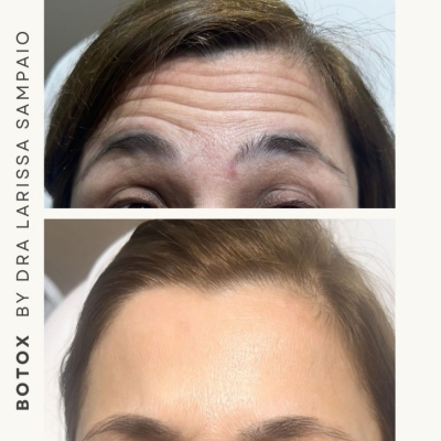 Botox