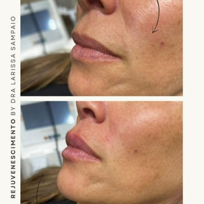 Rejuvenescimento Facial