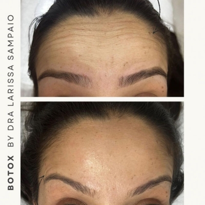 Botox