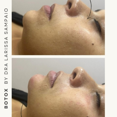 Botox
