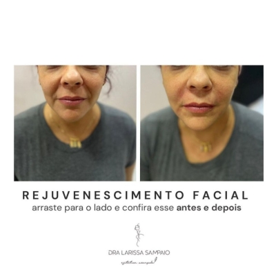 Rejuvenescimento Facial